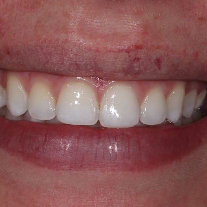 Icon Resin Infiltration – White Spot Removal